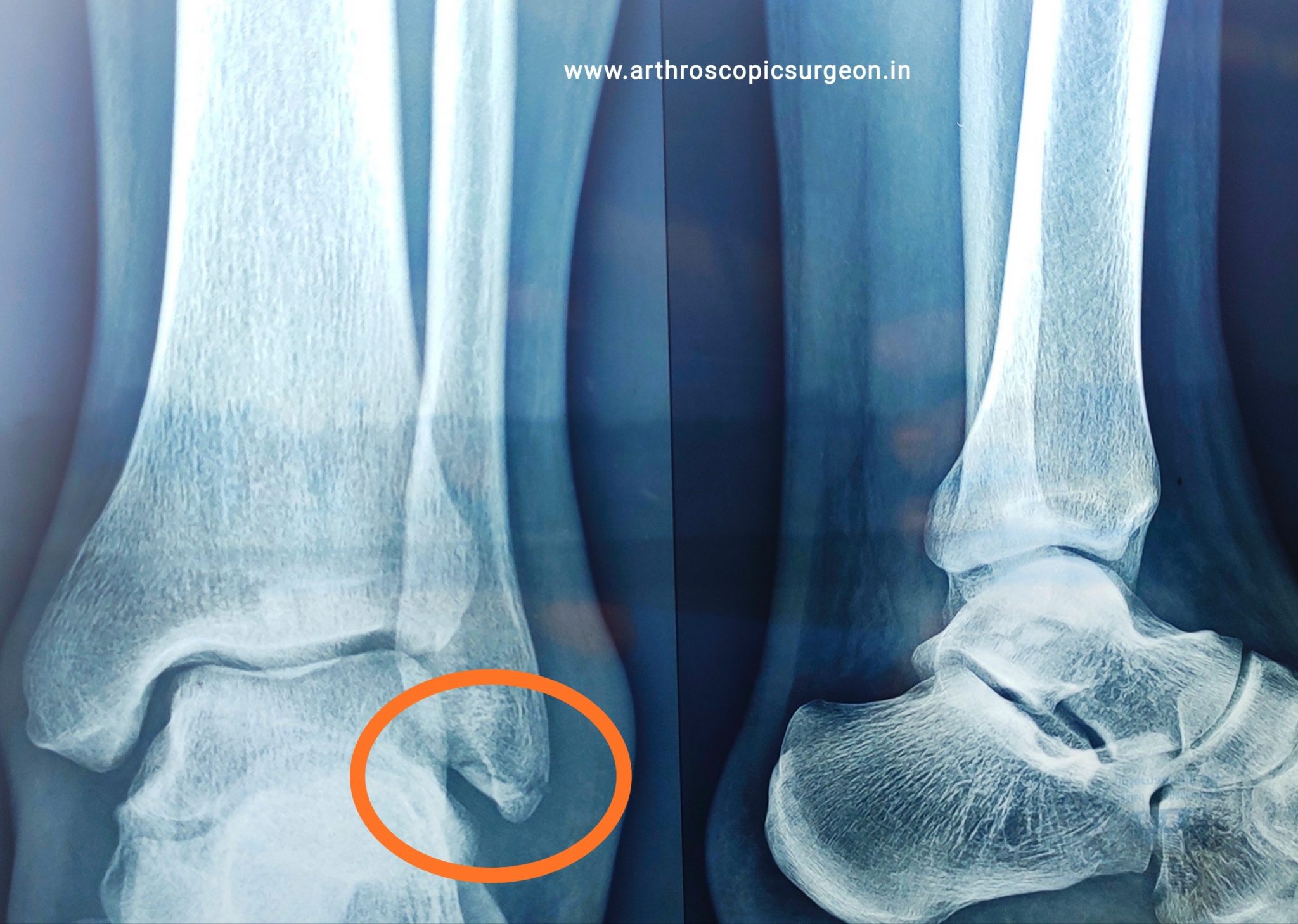 acute distal fibula fracture