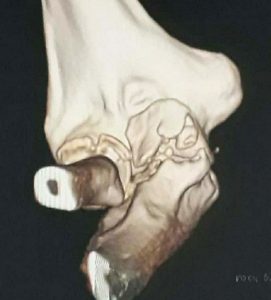terrible triad of elbow joint is very unstable injury of elbow joint. triad of elbow dislocation with radial head fracture with ulnar coronoid process fracture is known as terrible triad. In this injury medial collateral ligament of elbow is also mostly damaged so in this triad elbow joint becomes very unstable and surgical fixation should be done by experienced elbow surgeon.