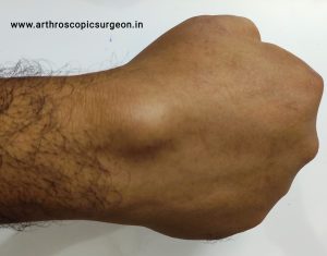 ganglion at wrist joint is very common condition and it may cause discomfort and pain in routine activities
